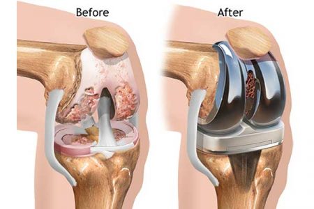 Price cap extension on knee implants will drive growth in India: GlobalData