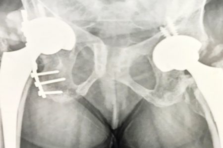 32-year-old operated to treat severe case of Ankylosing Spondylitis