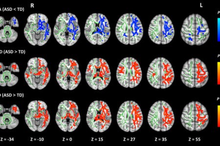 Researchers from Japan find how alterations in brain connectivity shape symptoms of Autism
